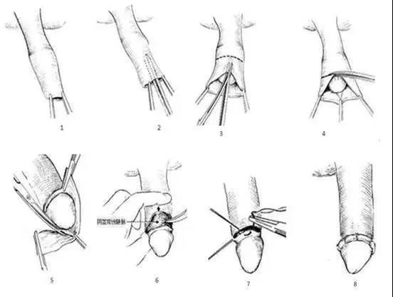 割包皮,四川省泌尿外科医院