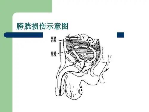 做结扎手术反倒把膀胱整到了？一键了解膀胱损伤