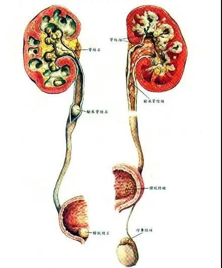 泌尿结石之八问八答