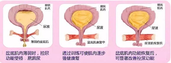 女性应该知道的盆底肌锻炼