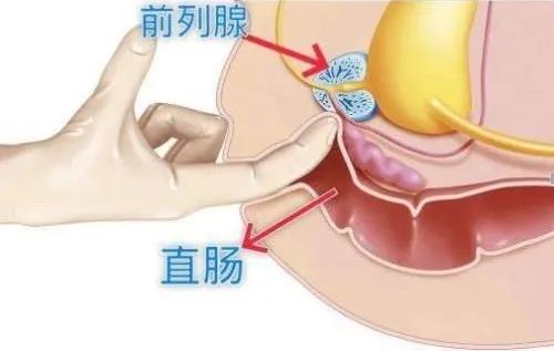 手淫会造成前列腺癌？吓得我手一紧...