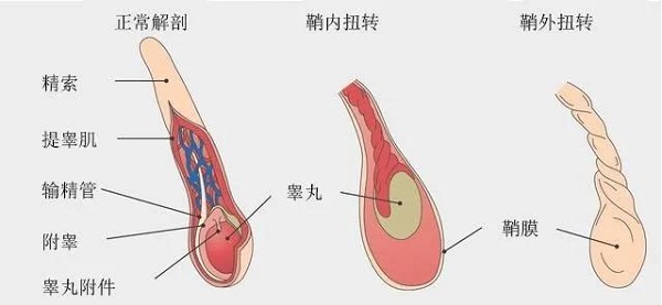 屋头有儿子的一定要看！睾丸270°扭转导致“蛋蛋”丢失