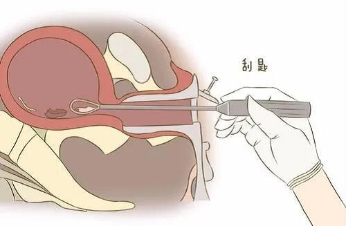 刮宫24次，80后女性丧失生育能力！