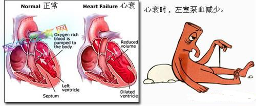 心力衰竭的健康宣教