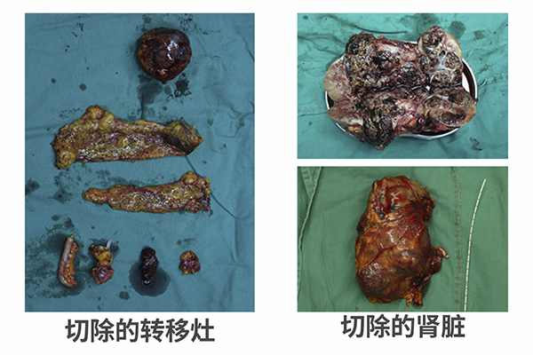 【特色医疗】四川泌尿外科医院成功完成一例独肾20公分肿瘤手术