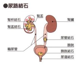 泌尿系结石危害大，三级预防有效远离