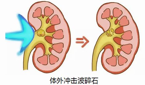 肾里长了结石，不要慌，看医生怎么把它取出来