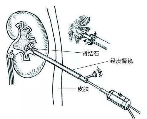 肾里长了结石，不要慌，看医生怎么把它取出来