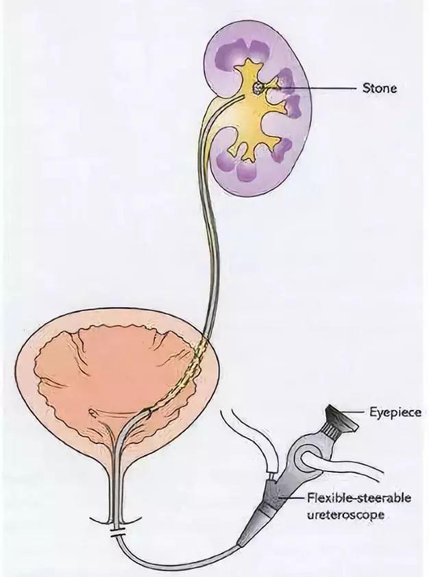 肾里长了结石，不要慌，看医生怎么把它取出来