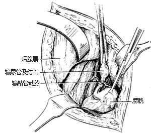 肾里长了结石，不要慌，看医生怎么把它取出来