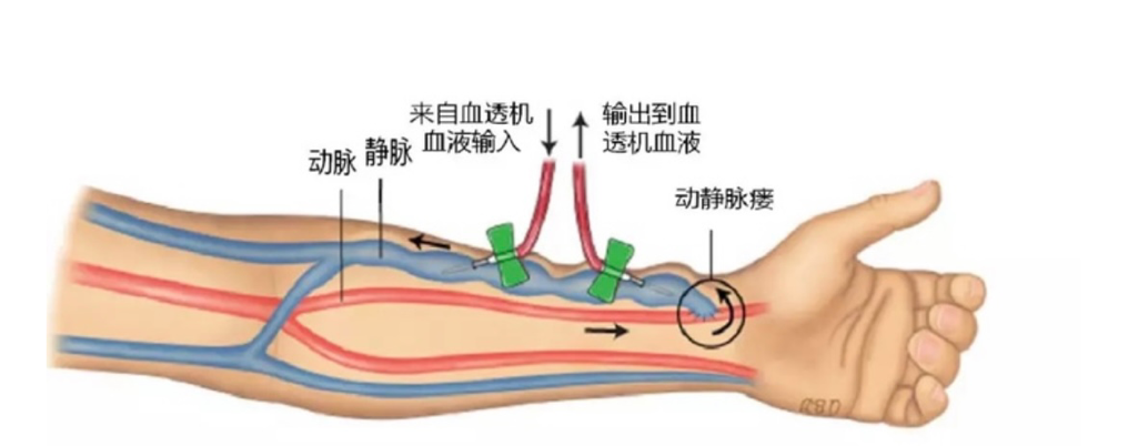 血管动静脉内瘘的保护