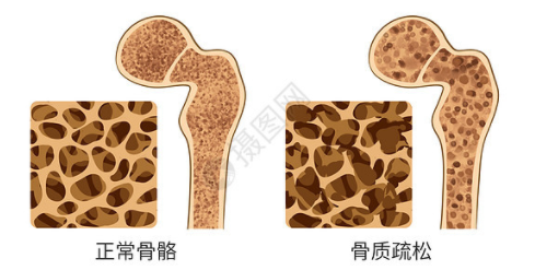 骨质疏松那些事