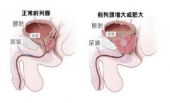 警惕！前列腺疾病应及早就医   避免生活受限