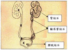 尿路结石是怎么形成的