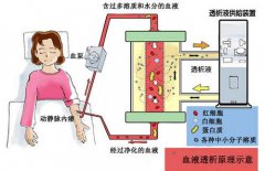 血液透析你了解多少？