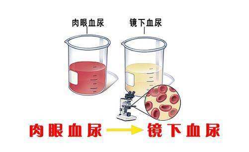 热搜：排队憋尿憋到尿血丨无痛血尿要小心……