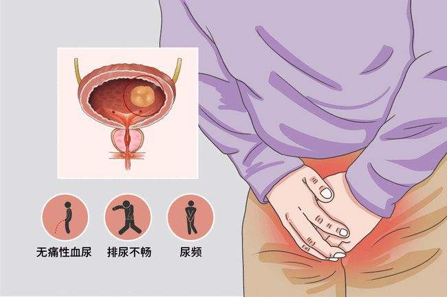 热搜：排队憋尿憋到尿血丨无痛血尿要小心……