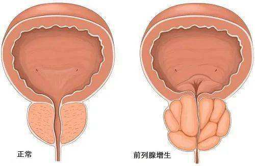 频频夜尿是水喝多了？也可能是这几种疾病在作怪！