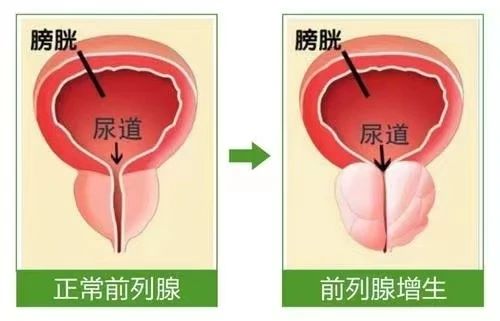 排尿困难8年 最后怎么样了