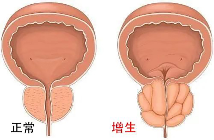 前列腺增生会不会复发？89岁老人有点懵