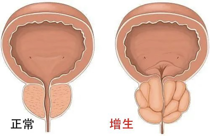 男性和女性膀胱的差异性